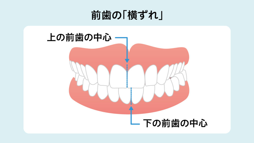 前歯の横ずれ